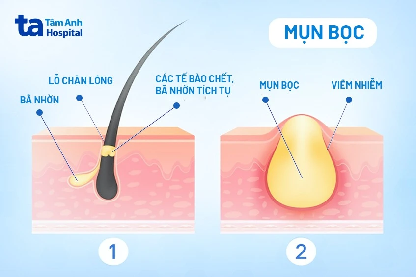 7 cách trị mụn bọc hiệu quả an toàn không để lại sẹo thâm