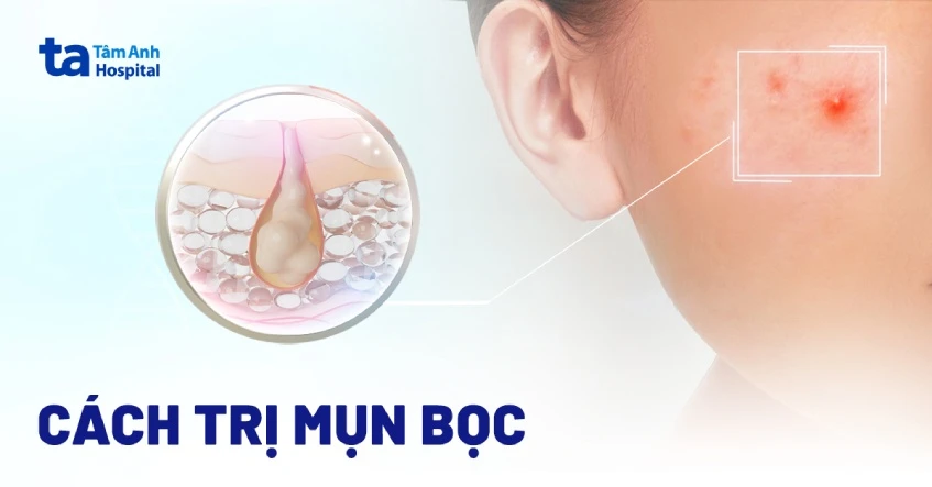 7 cách trị mụn bọc hiệu quả an toàn không để lại sẹo thâm