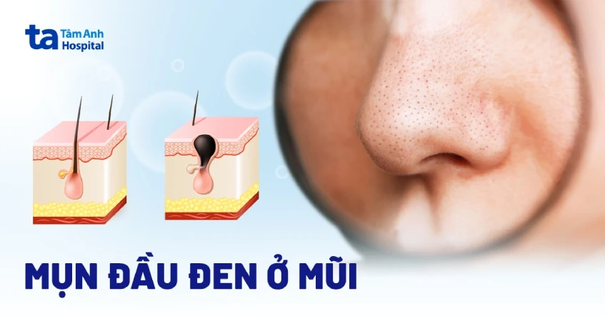 Mụn đầu đen ở mũi: Nguyên nhân, dấu hiệu, phòng ngừa