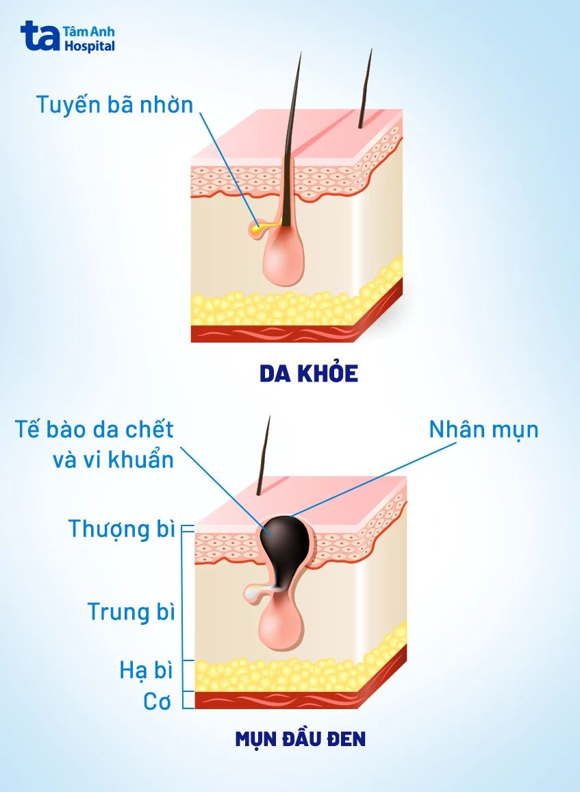 Mụn đầu đen ở mũi: Nguyên nhân, dấu hiệu, phòng ngừa