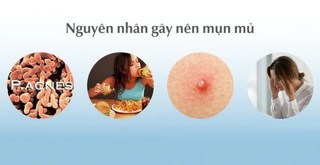 Top 13 cách trị mụn mủ hiệu quả, an toàn, không thâm sẹo