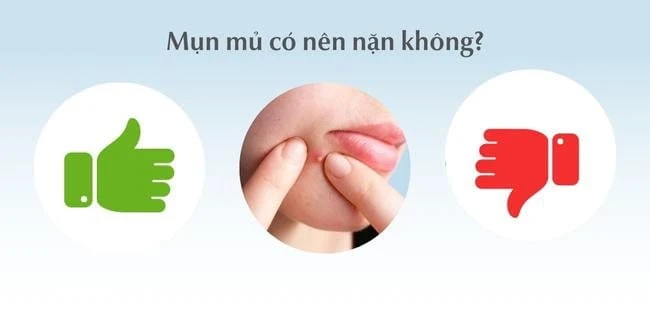 Top 13 cách trị mụn mủ hiệu quả, an toàn, không thâm sẹo