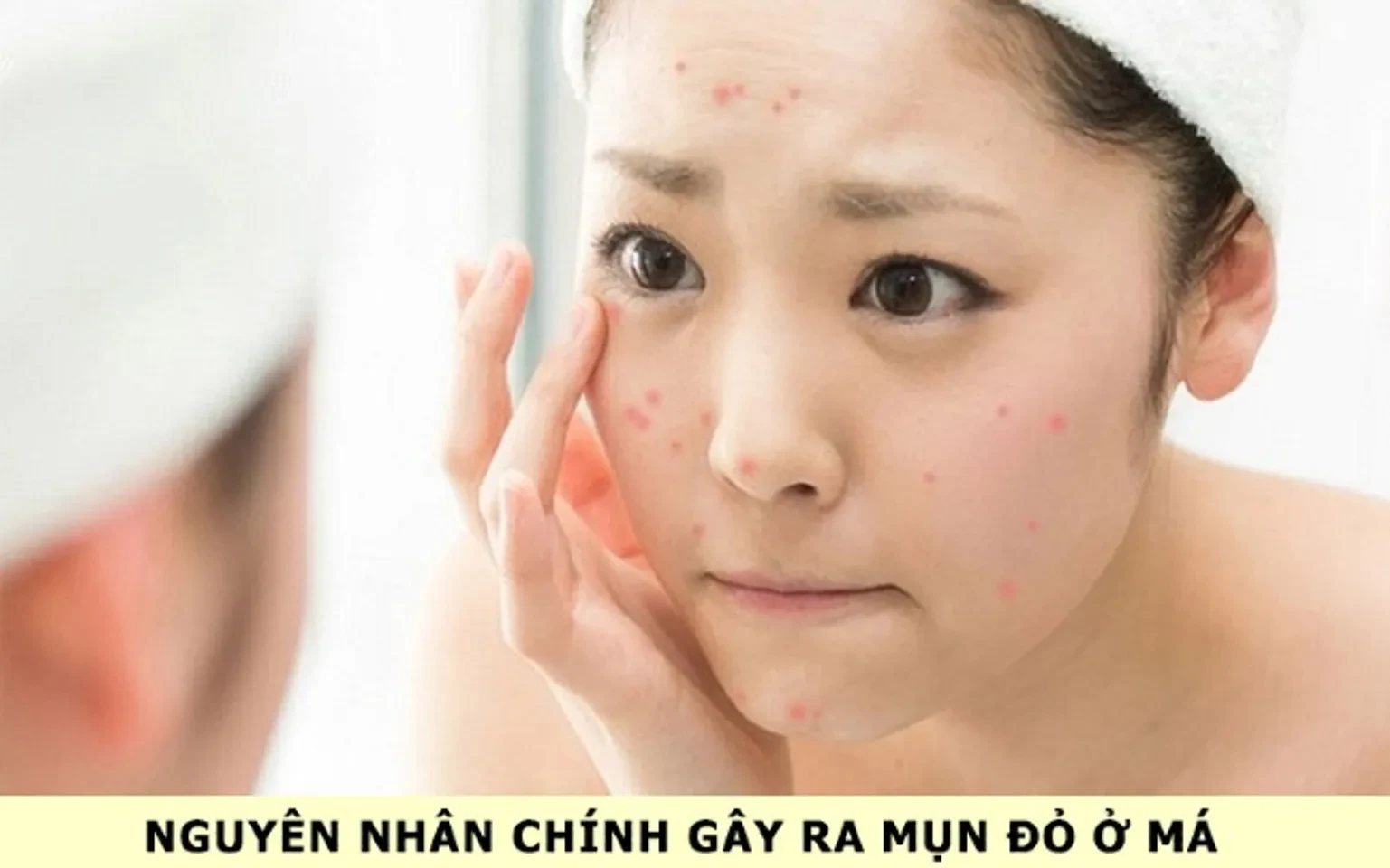 Top 11 cách trị mụn viêm đỏ không nhân tại nhà hiệu quả nhất