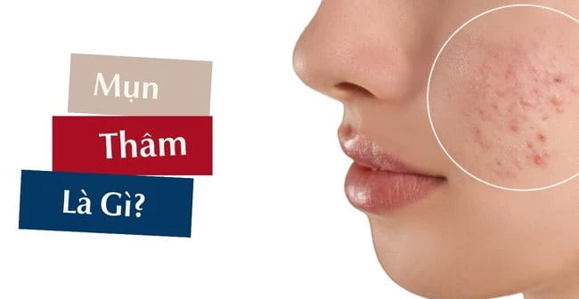 Cách trị vết thâm mụn ở mặt hiệu quả và an toàn