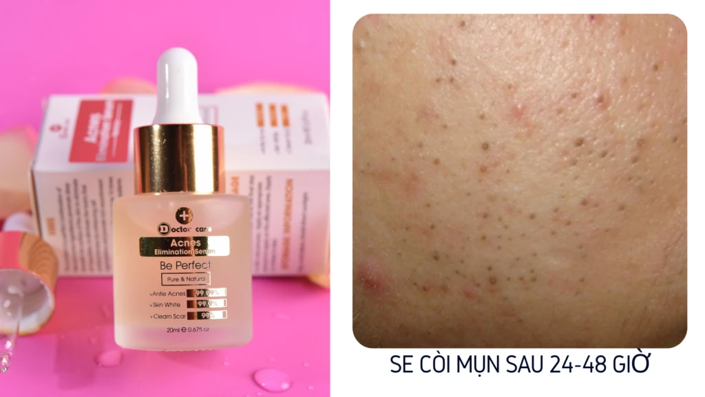 Serum trị mụn Doctorcare- trị mụn nhanh- an toàn- hiệu quả