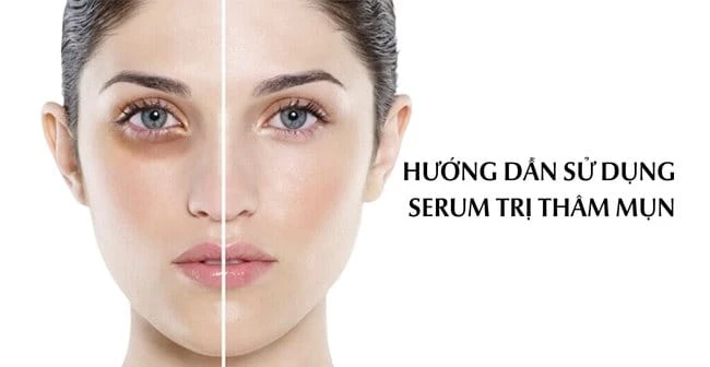 Top 10 serum trị thâm mụn tốt nhất hiệu quả sáng da nhanh chóng