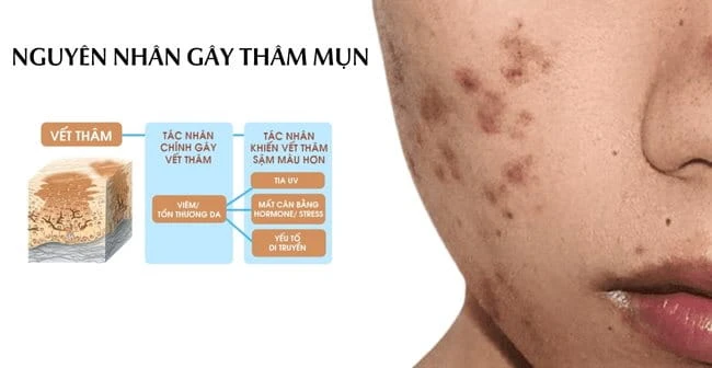 Serum trị thâm mụn hiệu quả sau điều trị mụn