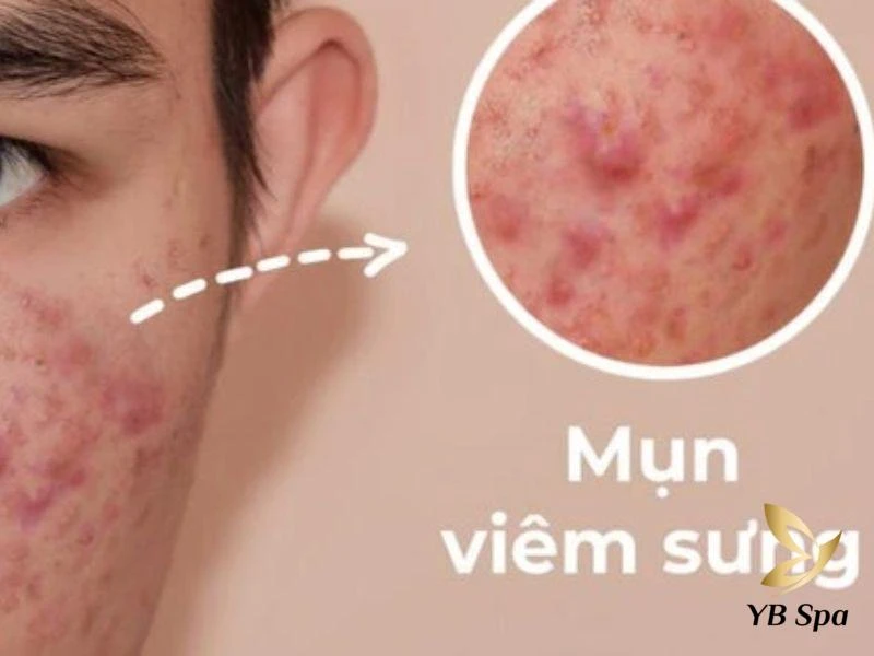 Nên bôi kem trị mụn trước hay sau serum? Cách bôi đúng chuẩn