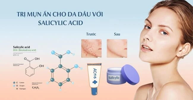 15 Cách trị mụn ẩn dưới da tại nhà an toàn hiệu quả