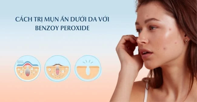 15 Cách trị mụn ẩn dưới da tại nhà an toàn hiệu quả