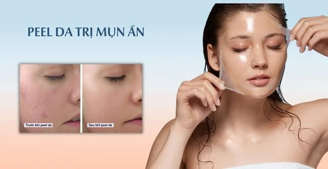 15 Cách trị mụn ẩn dưới da tại nhà an toàn hiệu quả