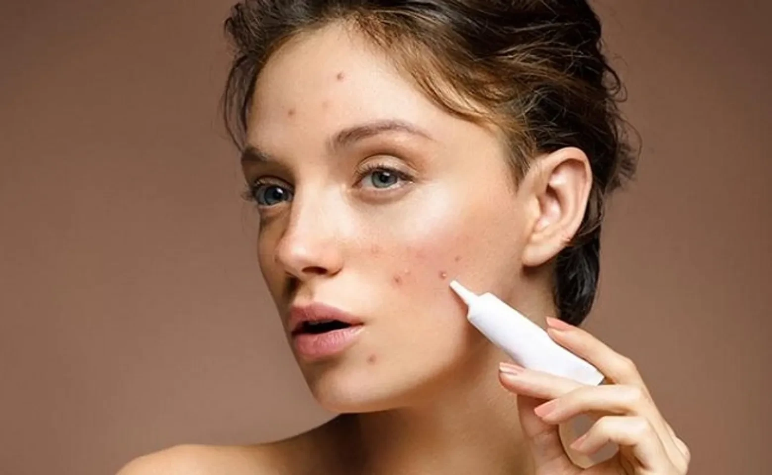 TOP 10+ gel trị mụn đánh bay mọi loại mụn thường gặp hiện nay