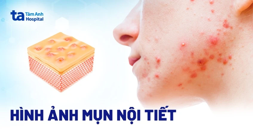 Hình ảnh mụn nội tiết dễ nhận biết, không nên chủ quan